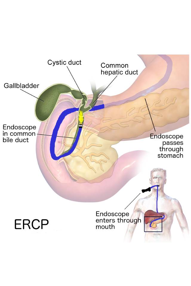 ERCP procedure diagram