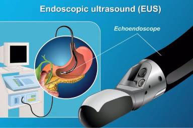 Endoscopic ultrasound (EUS) diagram